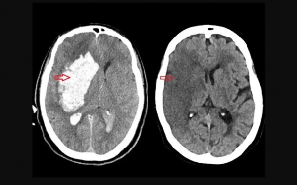 Brasil perde uma vida a cada seis minutos por AVC, mas maioria dos casos é evitável