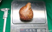 Médicos retiram de um homem a maior pedra no rim do mundo