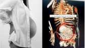 Idosa de 81 anos descobre estar ‘gestando’ feto calcificado há cinco décadas