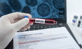 Casos de mpox no Brasil chegam a 945 e já superam o total de 2023