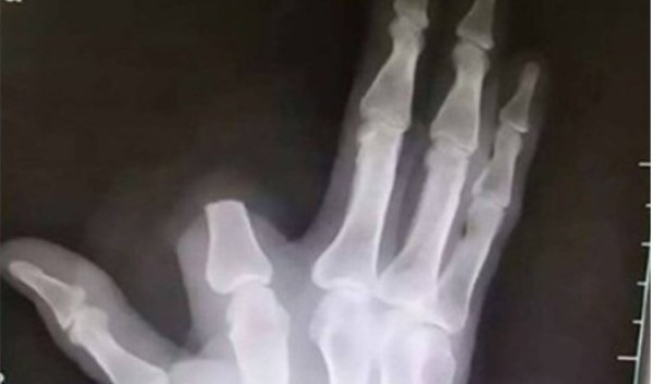 Agricultor corta o próprio dedo à toa após ser picado por cobra