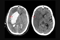Brasil perde uma vida a cada seis minutos por AVC, mas maioria dos casos é evitável
