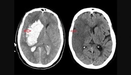 Brasil perde uma vida a cada seis minutos por AVC, mas maioria dos casos é evitável